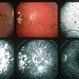 Choroiditis Choroiditis